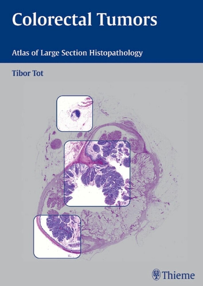 Colorectal Tumors main product photo