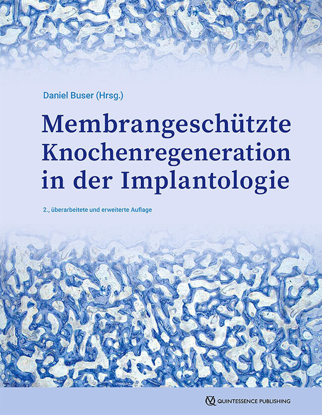 Membrangeschützte Knochenregeneration in der Implantologie main product photo