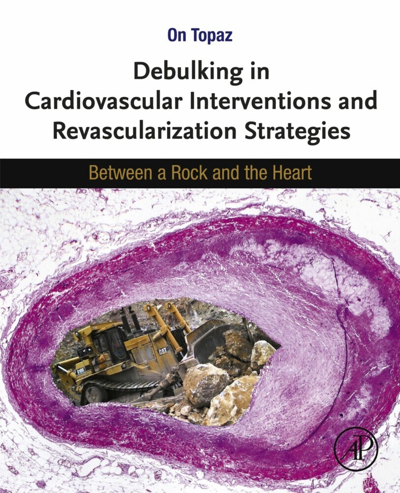 Debulking in Cardiovascular Interventions and Revascularization Strategies main product photo