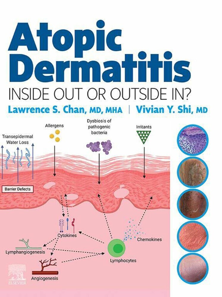 Atopic Dermatitis: Inside Out or Outside In - E-Book main product photo
