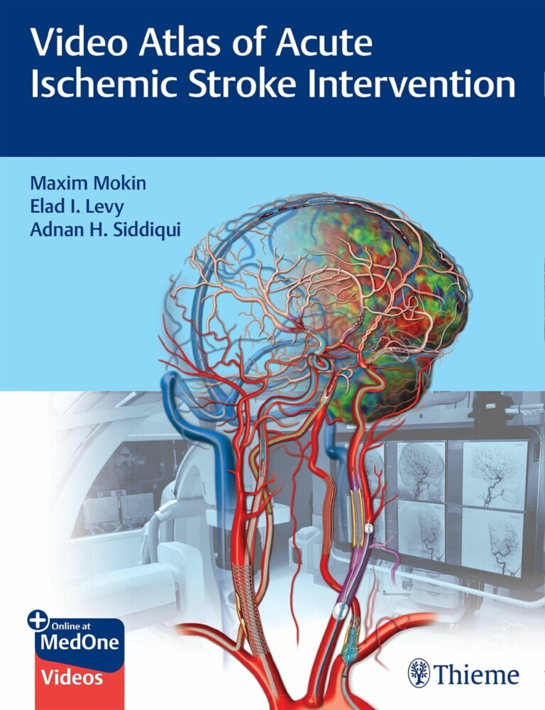 Video Atlas of Acute Ischemic Stroke Intervention main product photo