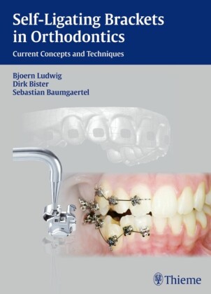 Self-Ligating Brackets in Orthodontics