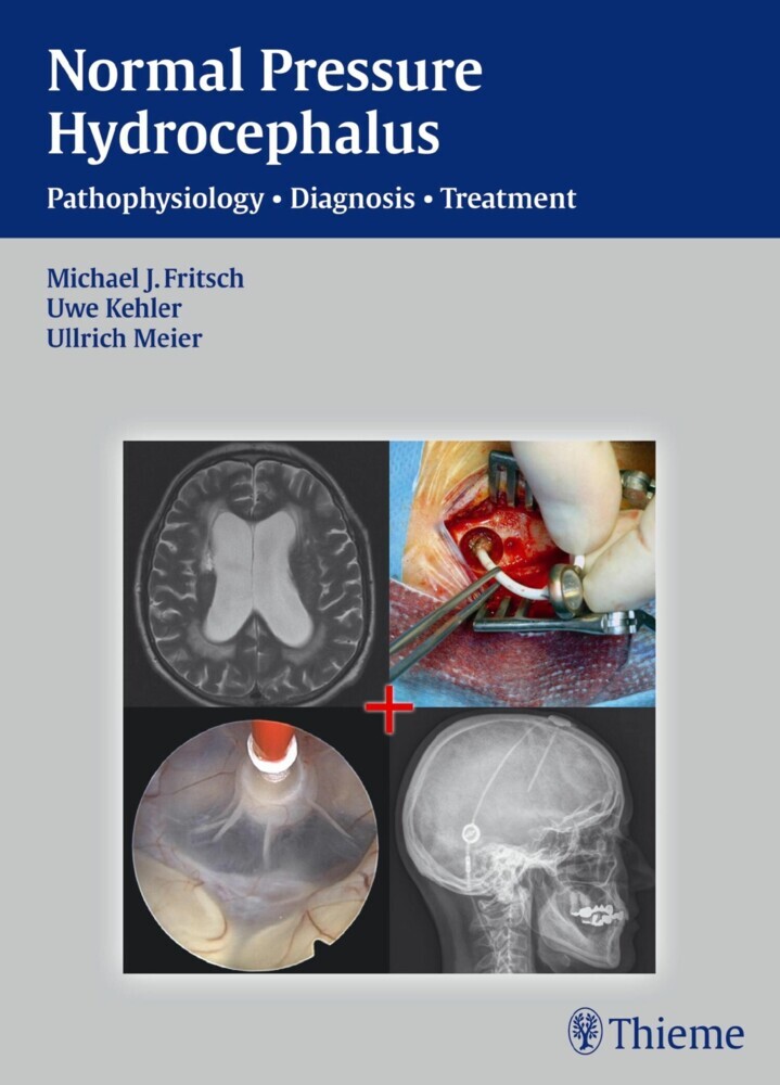 Normal Pressure Hydrocephalus main product photo