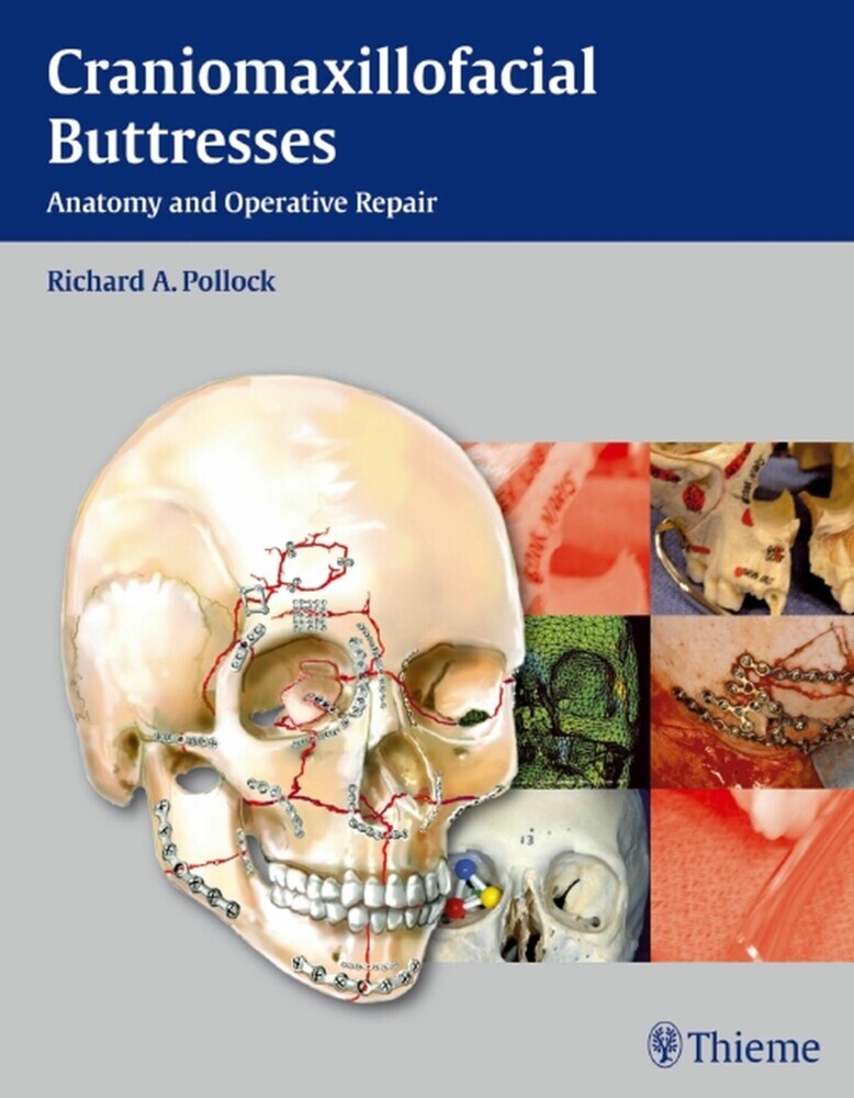 Craniomaxillofacial Buttresses main product photo