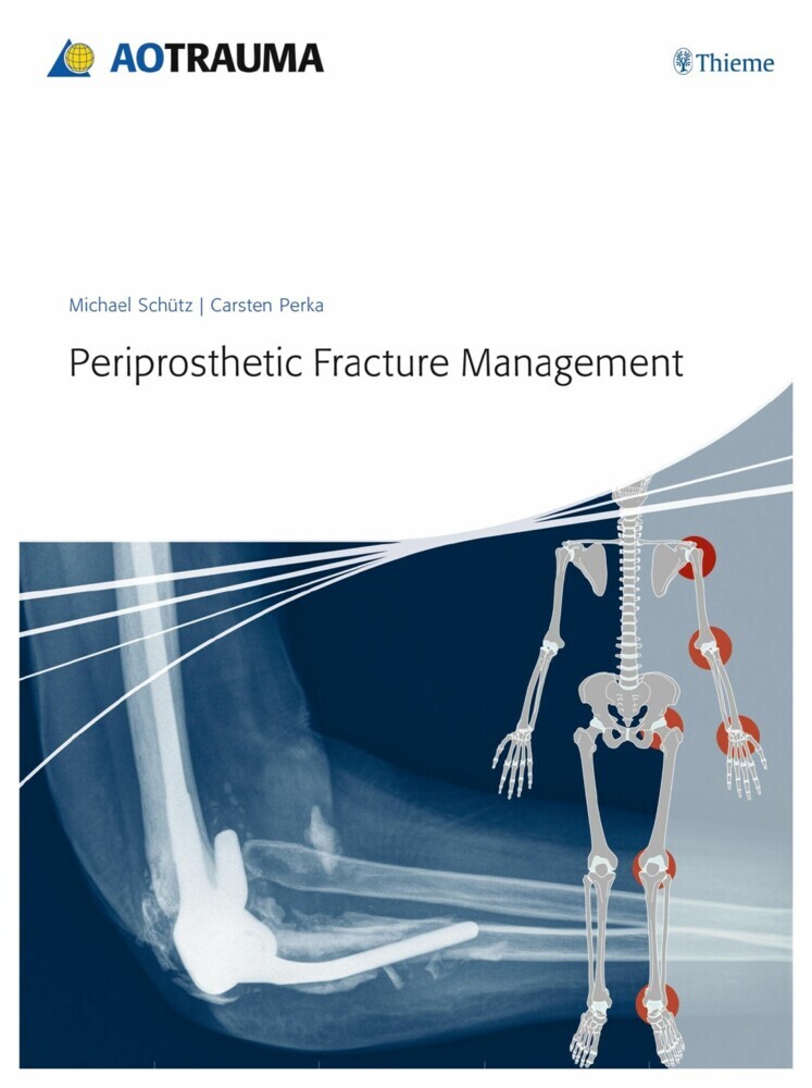 Periprosthetic Fracture Management main product photo