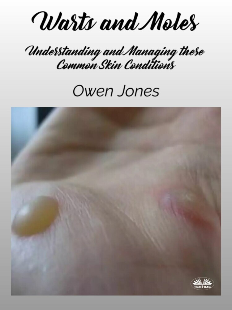 Warts And Moles main product photo