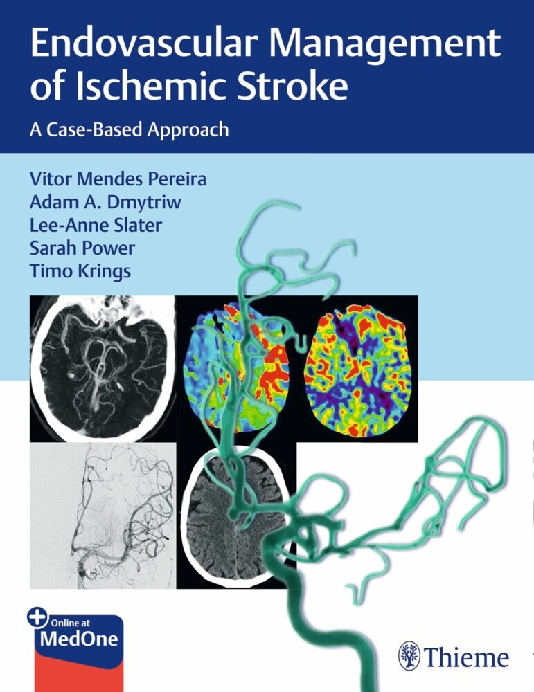 Endovascular Management of Ischemic Stroke main product photo
