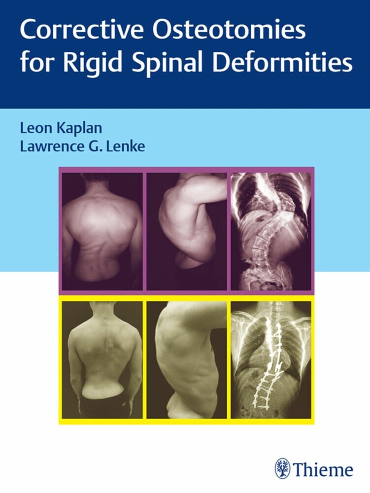 Corrective Osteotomies for Rigid Spinal Deformities main product photo