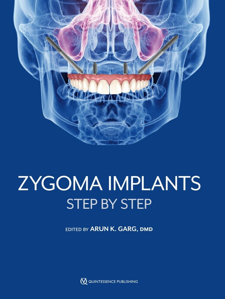 Zygoma Implants main product photo