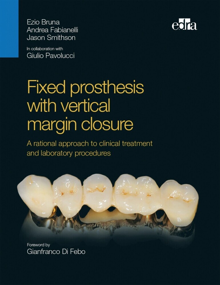 Fixed prosthesis with vertical margin closure main product photo
