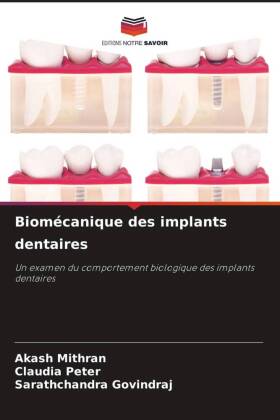 Biomécanique des implants dentaires