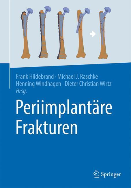 Periimplantäre Frakturen main product photo