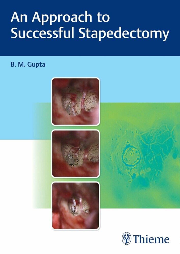 An Approach to Successful Stapedectomy main product photo