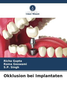 Okklusion bei Implantaten