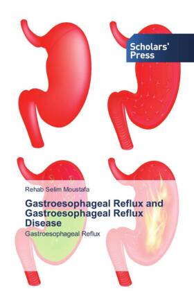Gastroesophageal Reflux and Gastroesophageal Reflux Disease