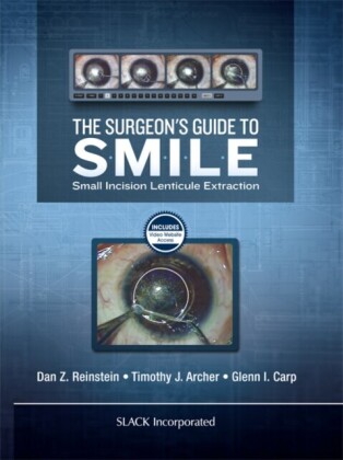Surgeon's Guide to SMILE