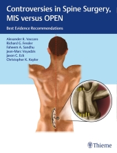Controversies in Spine Surgery: MIS versus OPEN