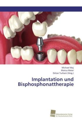 Implantation und Bisphosphonattherapie 