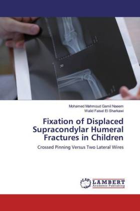 Fixation of Displaced Supracondylar Humeral Fractures in Children 
