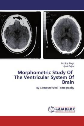 Morphometric Study Of The Ventricular System Of Brain 