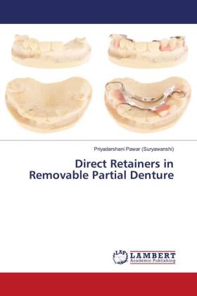 Direct Retainers in Removable Partial Denture 