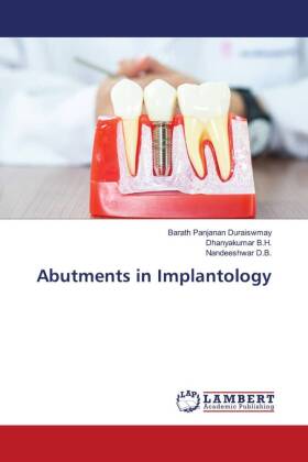 Abutments in Implantology 