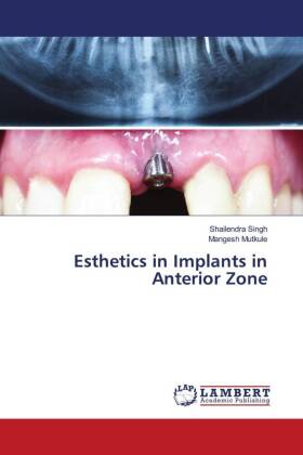Esthetics in Implants in Anterior Zone 